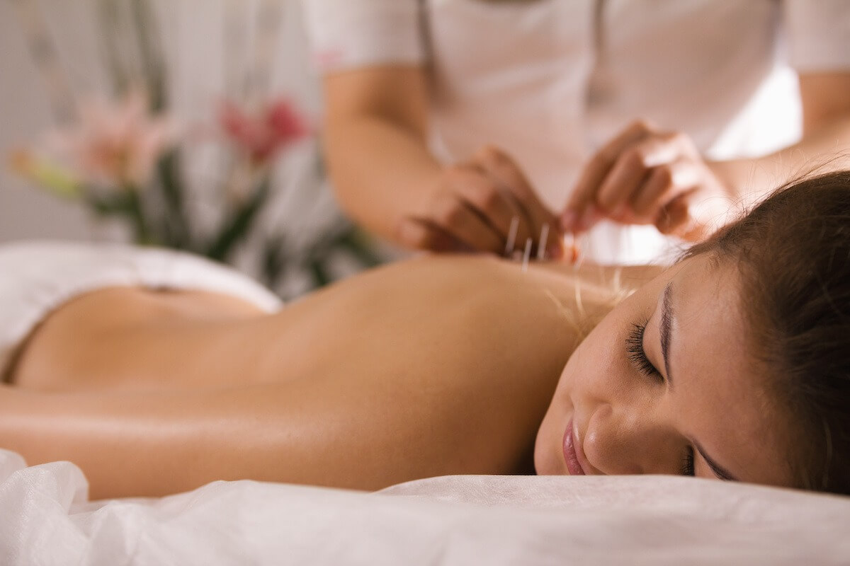 Woman in an Acupuncture Session